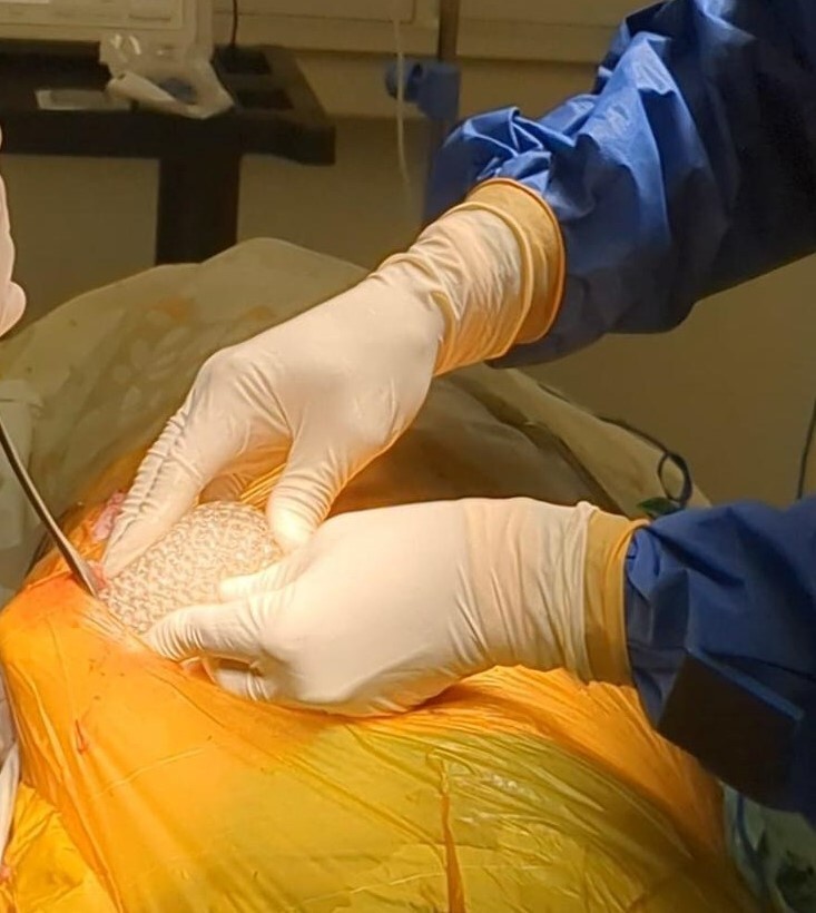 "CollPlant's printed regenerative breast implant implantation procedure, as part of the preclinical trial" (PRNewsfoto/CollPlant)